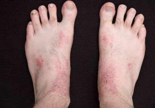 Лечение дерматита на ногах: фото, симптомы, причины, народные ...