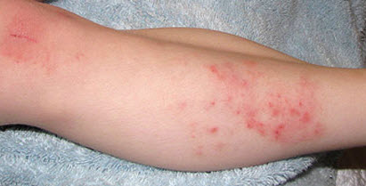 Лечение дерматита на ногах: фото, симптомы, причины, народные ...