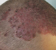 Симптомы псориаза на голове