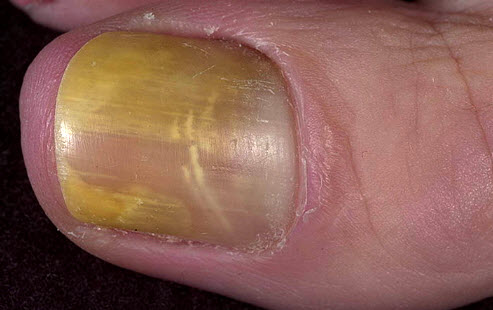 Симптомы микоза-грибка ногтей